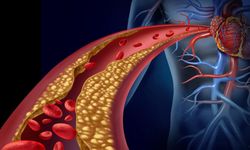 "Kolesterolün Fazlası Felce Davetiye Çıkarıyor"