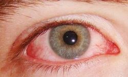 Sürekli Gözünüz Kaşınıyorsa Dikkat: Kirpik Dibi Paraziti Olabilir