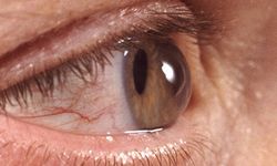 "Glokom Belirti Vermeden Görme Kaybına Yol Açabilir"