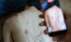 Down Sendromlu Oğlunun Vücudundaki İzleri Görünce Soluğu Önce Hastanede Ardından Adliyede Aldı