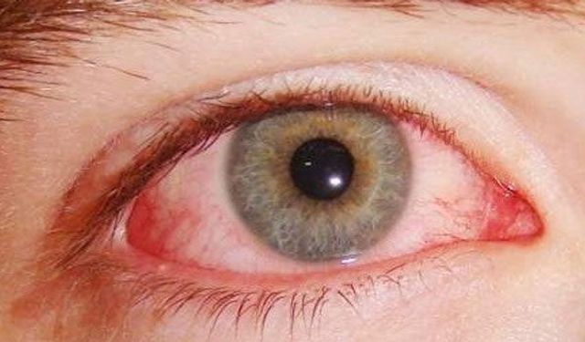 Sürekli Gözünüz Kaşınıyorsa Dikkat: Kirpik Dibi Paraziti Olabilir