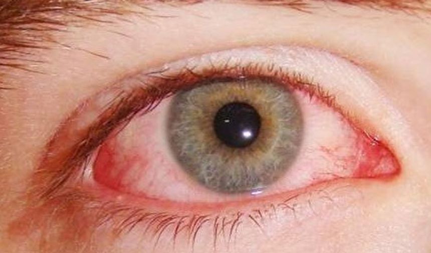 Sürekli Gözünüz Kaşınıyorsa Dikkat: Kirpik Dibi Paraziti Olabilir
