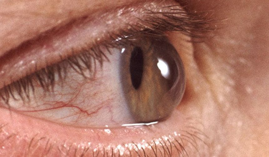 "Glokom Belirti Vermeden Görme Kaybına Yol Açabilir"